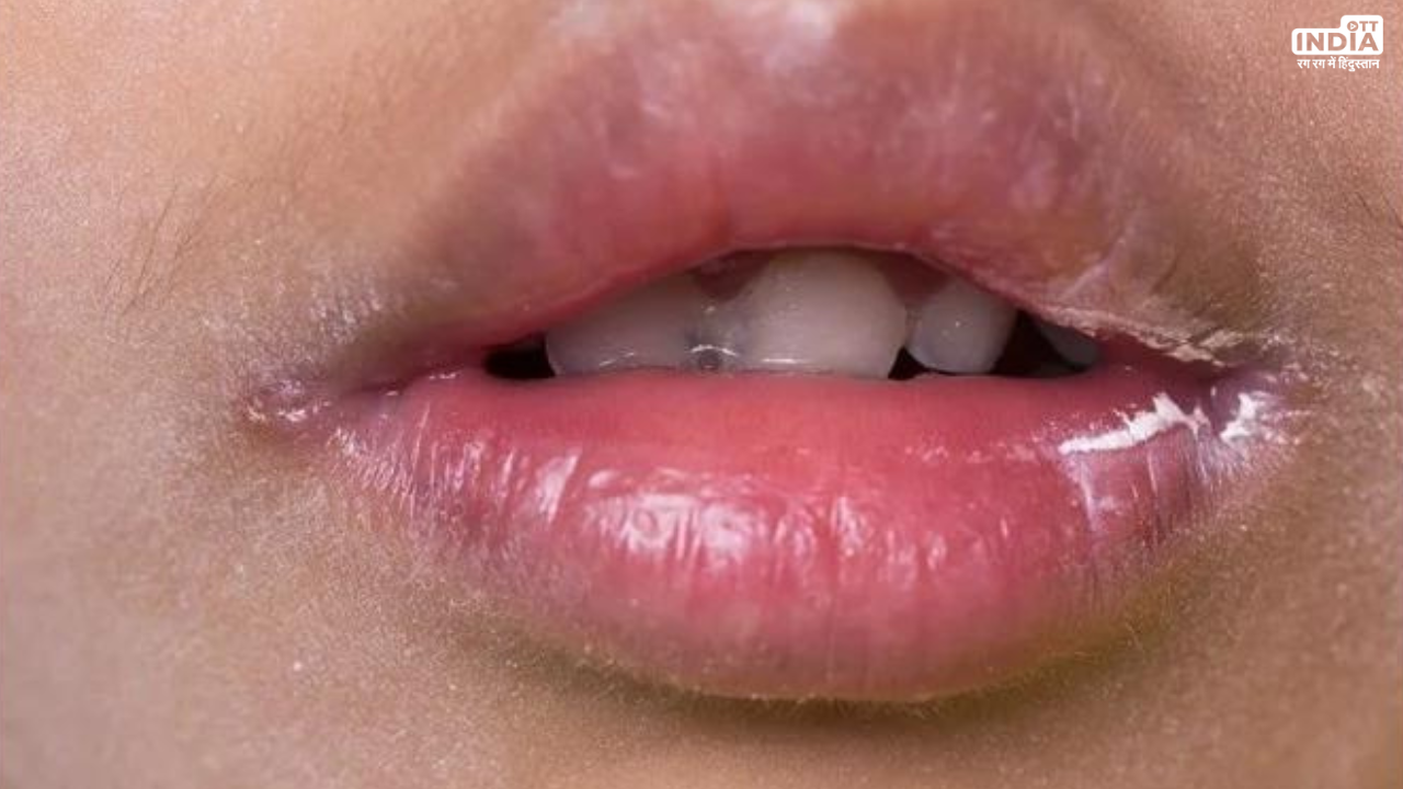 Angular Cheilitis Home Remedies: क्या आपके होठों के किनारों पर पड़ती हैं दरारें, जानें इसका घरेलु इलाज