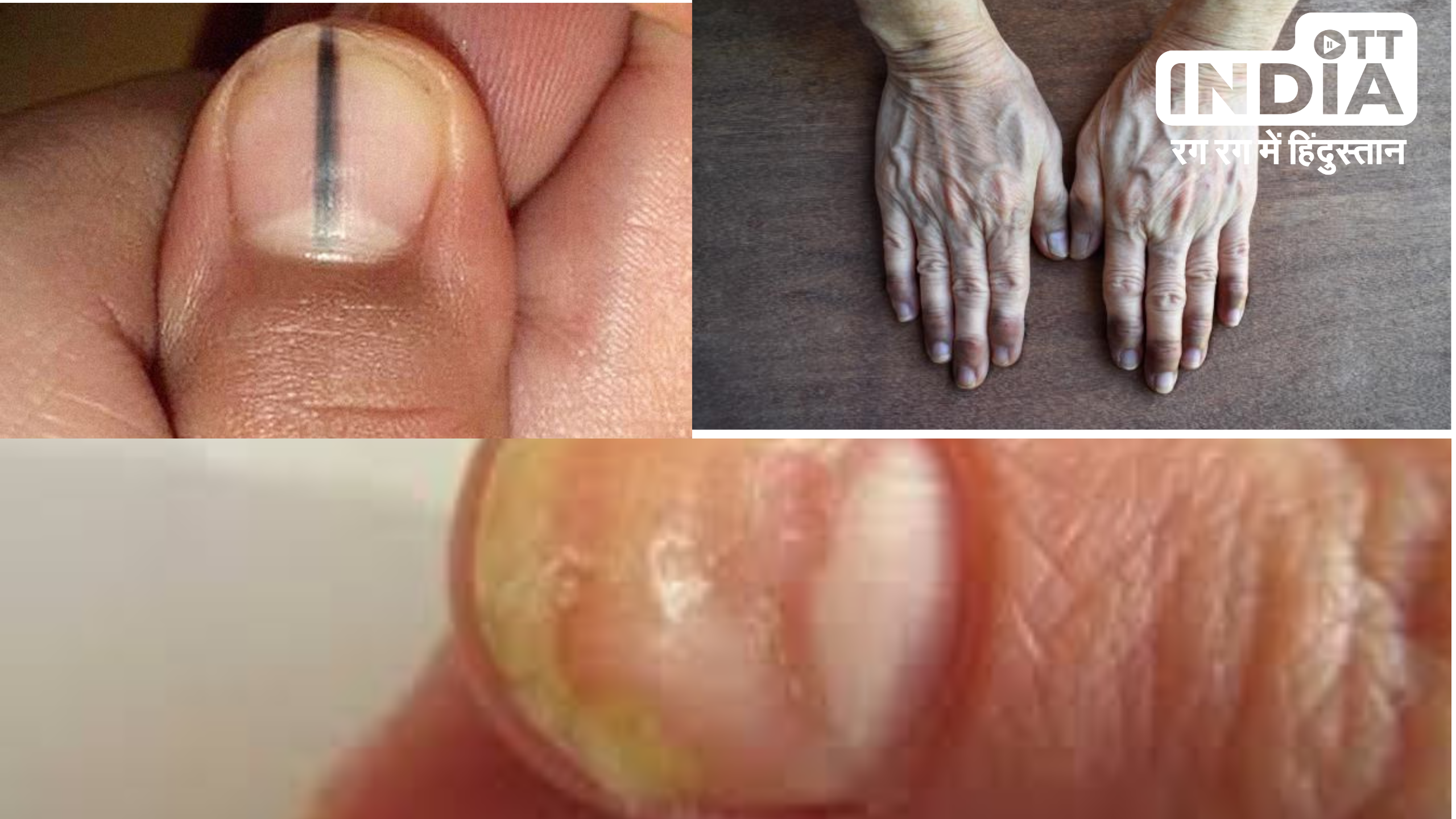 Nails Sign Of Diseases  : नाखूनों के बदलते रंग गंभीर बीमारियों के हो सकते हैं संकेत , जानिये विस्तार से