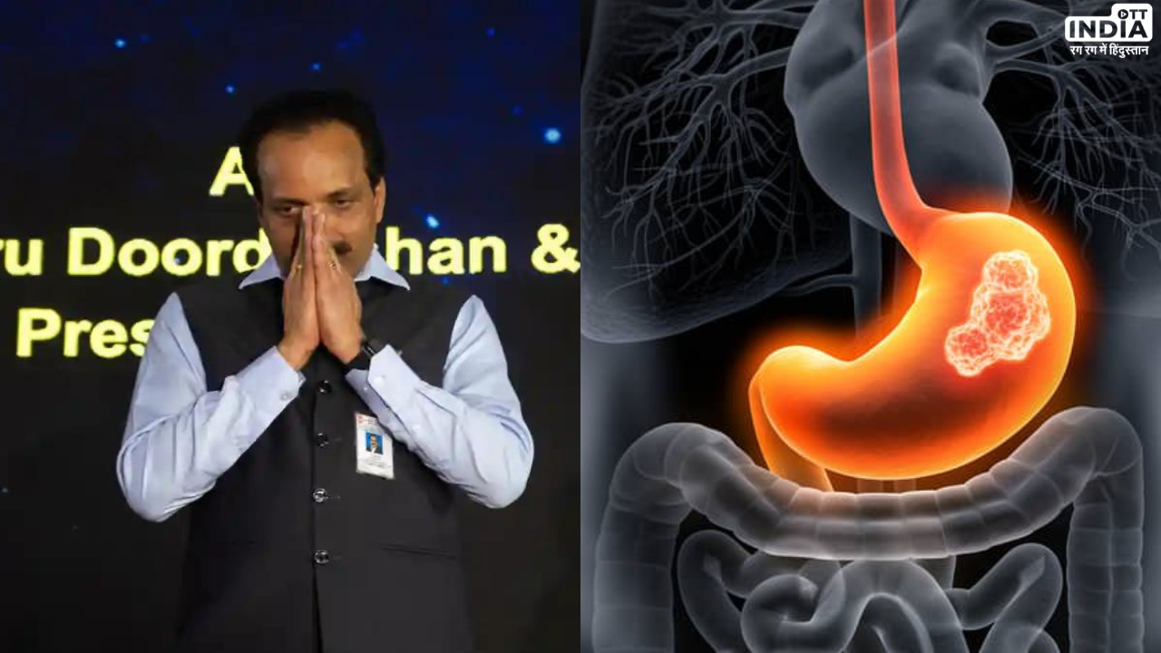 Gastric Cancer: क्या होता है गैस्ट्रिक कैंसर जिसके इसरो चीफ सोमनाथ हुए थे शिकार, जानिये कारण, लक्षण और उपचार