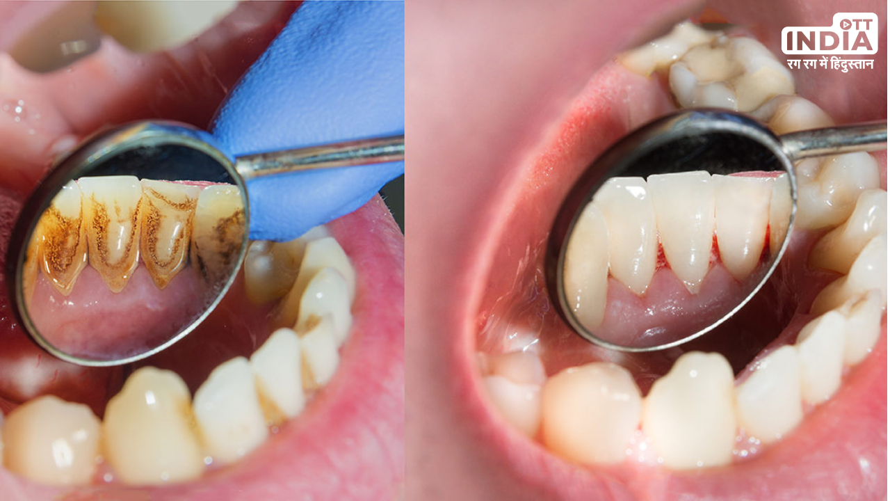 Dental Plaque: जानें क्यों जमा होता है दाँतों में प्लाक, इन घरेलू  उपायों से करें दूर
